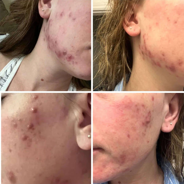 Rehab Serum: Say Goodbye to Blemishes